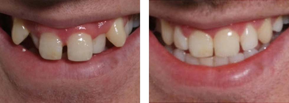 Teeth straightening case study